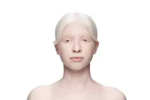 rêver d'albinos